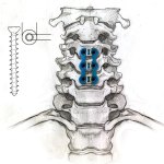 Anterior-C-Plate