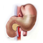 Superior-Mesenteric-Artery-Syndrome